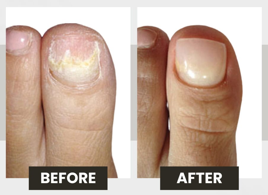 Keryflex Before/after - 1